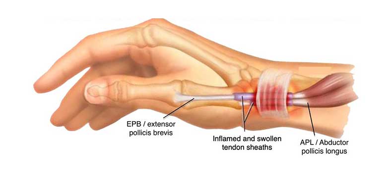 Başparmak Tendonunun Sıkışması
