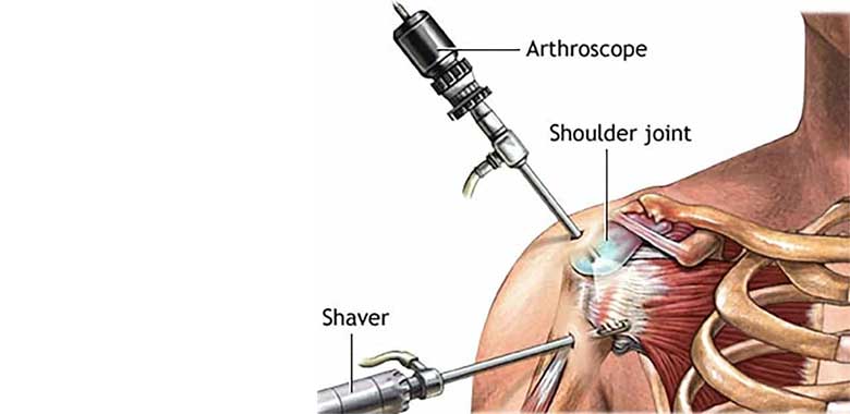 Omuz Artroskopisi Sonrasında İyileşme Dönemi Nasıldır ?