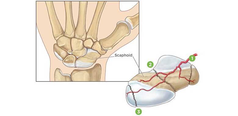 Skafoid Kırıkları
