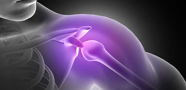 Subacromial Impingement Syndrome