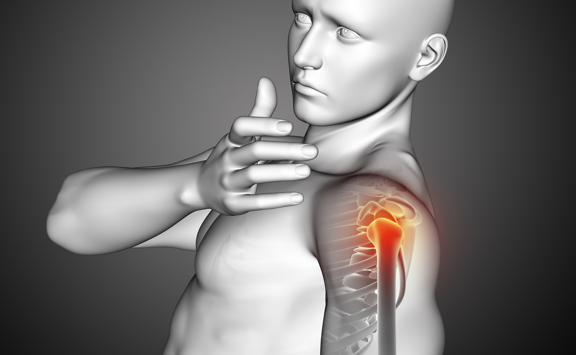 Subakromiyal impingement Sendromu (SIS)